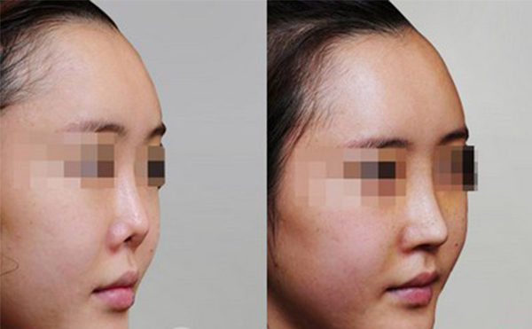 修復(fù)后的鼻翼缺損是否真實(shí)？