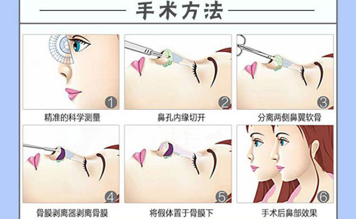 隆鼻假體取出后能恢復(fù)到以前嗎？