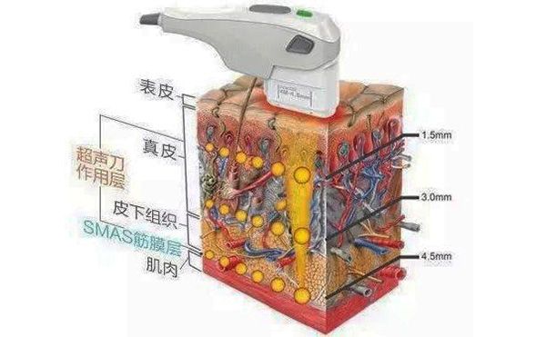 超聲刀的原理是什么?效果怎么樣?