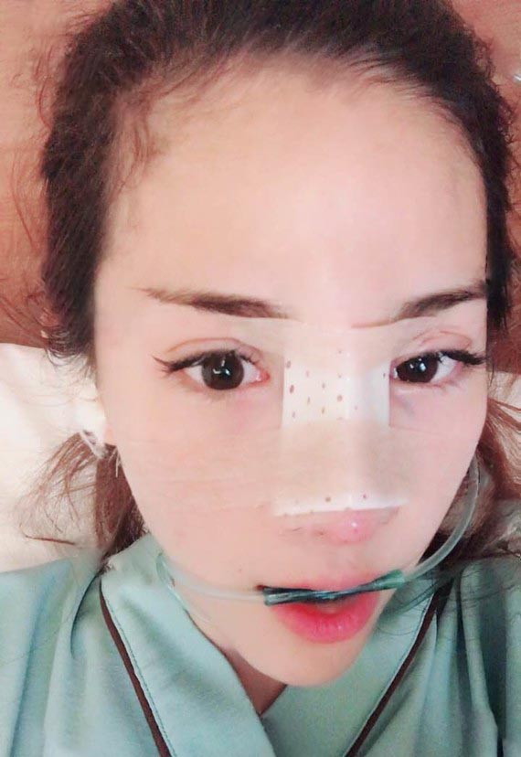 洛陽(yáng)醫(yī)生隆鼻效果