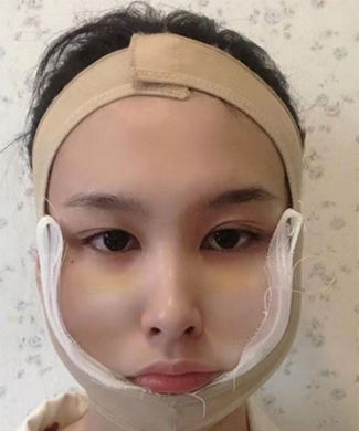 下頜角磨骨