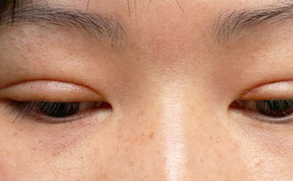 埋線雙眼皮失敗該如何修復？多久修復好？