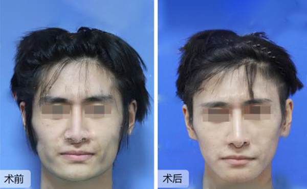 做下頜角整形風(fēng)險有哪些？
