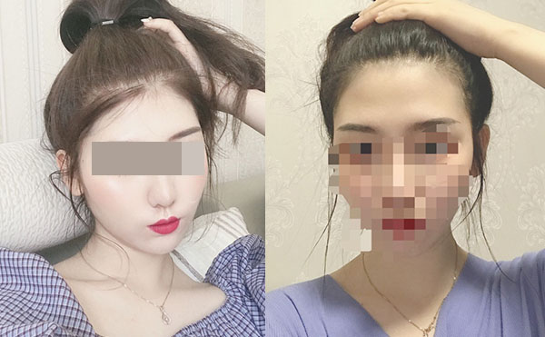 冰點(diǎn)脫毛后多久可以洗澡嗎？