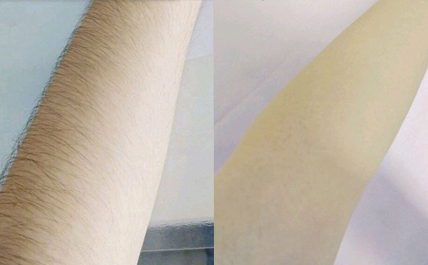 光子脫毛有疼痛感嗎？