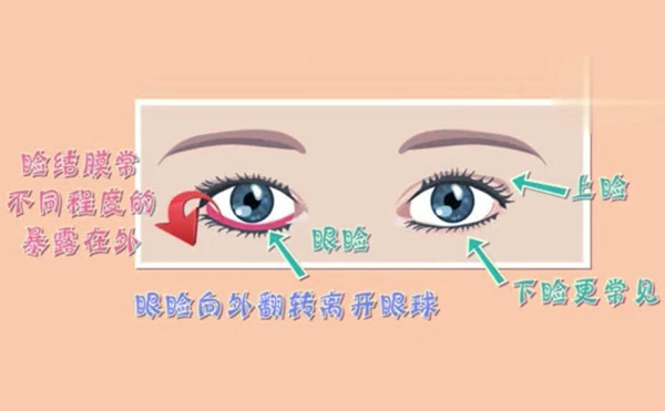 眼瞼外翻的矯治原理是什么?眼瞼外翻矯正有哪些禁忌?