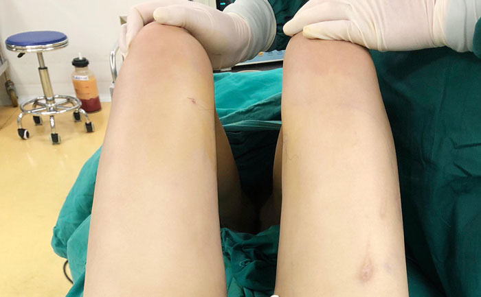 腿部吸脂手術(shù)大約多少錢？腿部吸脂多久后腿部恢復正常？