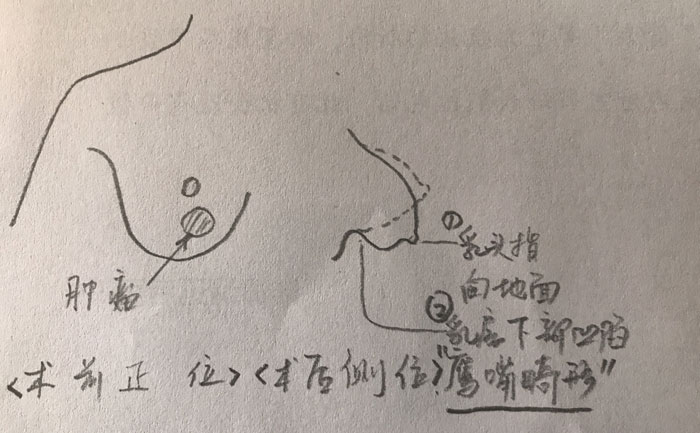 乳房畸形是什么原因造成的？乳房畸形矯正手術(shù)方法？