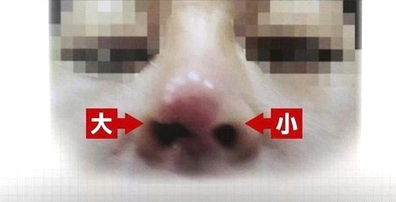 隆鼻手術