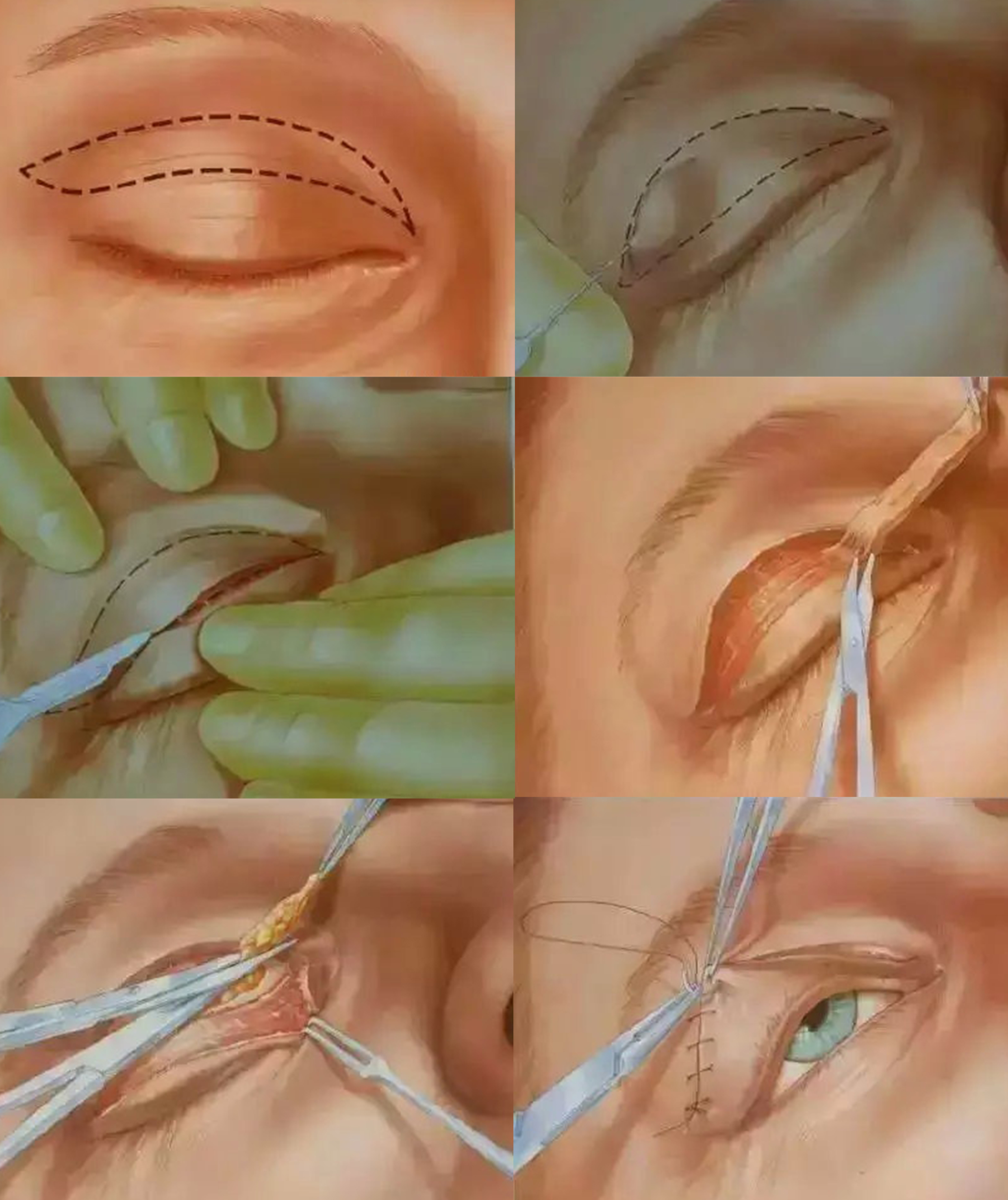 雙眼皮去脂