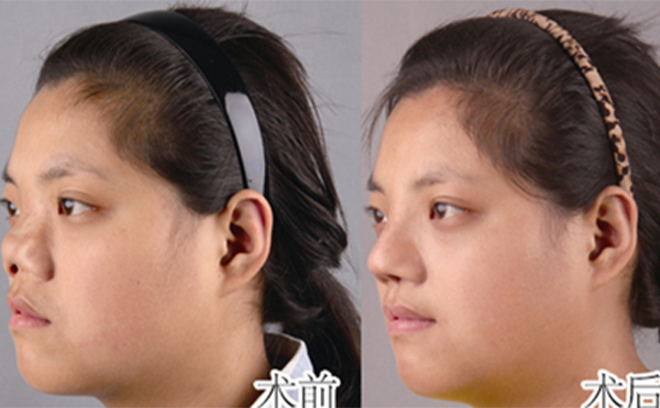 全鼻再造的方法有哪些?術(shù)后護理怎么做