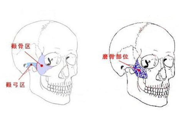 顴骨整形一般是從哪里切口？