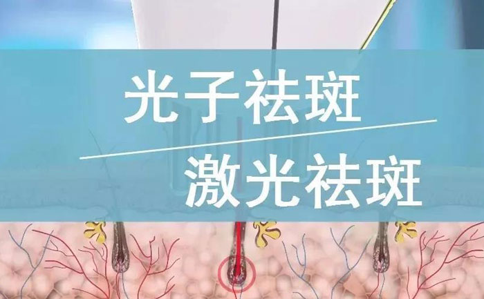 光子祛斑效果如何？