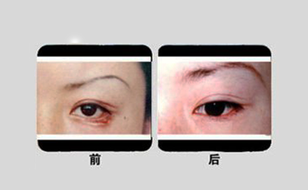 眼瞼外翻手術步驟是什么?有什么優(yōu)勢?