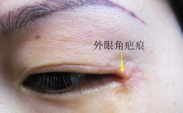 開(kāi)外眼角有什么后遺癥?開(kāi)外眼角效果明顯嗎?