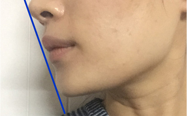 做假體墊下巴恢復(fù)后會被摸出來做過嗎？還能打玻尿酸嗎？