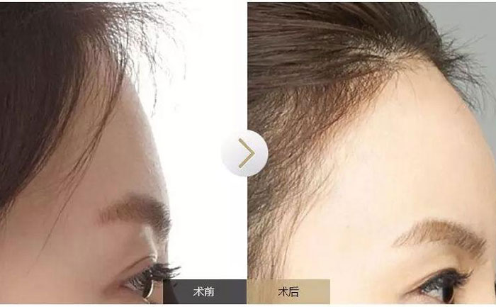 額頭填充術可以保持多久？