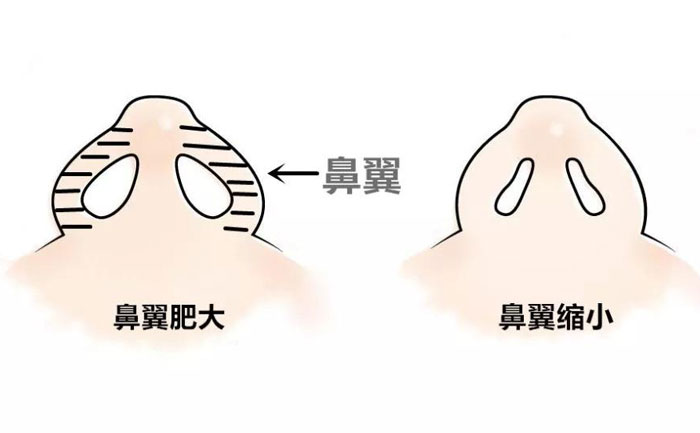鼻翼縮小手術(shù)要做多久？