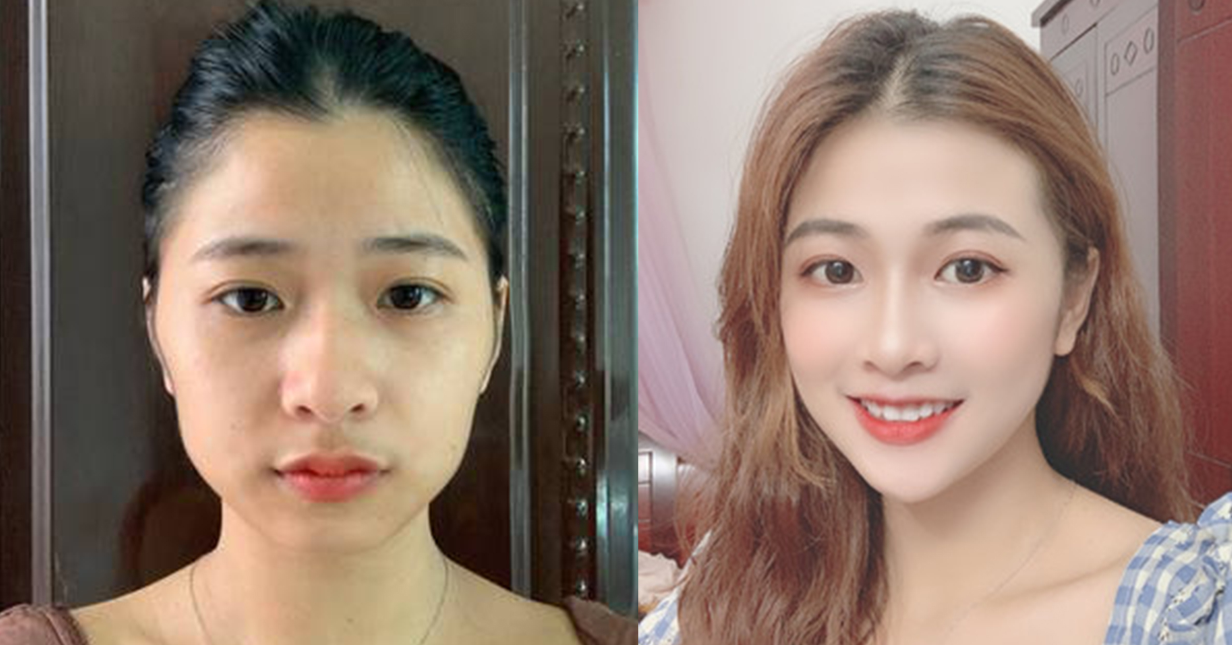 脂肪填充手術效果對比