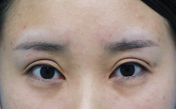 切開(kāi)雙眼皮手術(shù)做失敗了怎么辦?