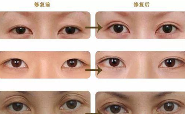 雙眼皮修復(fù)可靠嗎？什么時(shí)候做雙眼皮修復(fù)比較好？