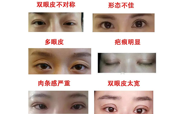 哪些情況需做雙眼皮修復(fù)？修復(fù)難度大不大?