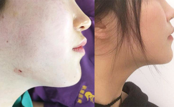 面部吸脂恢復(fù)期多長(zhǎng)時(shí)間？