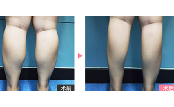boxo瘦腿有什么優(yōu)勢(shì)？