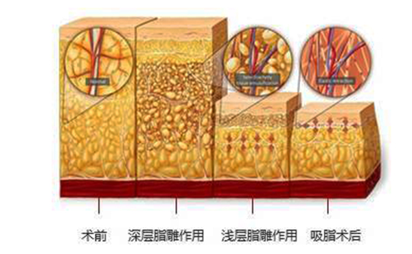 韓式分層吸脂的效果怎么樣？