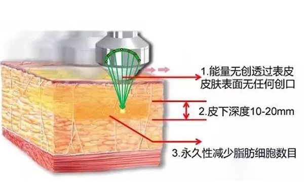 超聲波吸脂怎么瘦手臂？