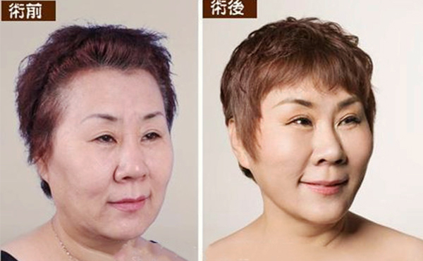 拉皮手術(shù)多久能恢復(fù)自然？