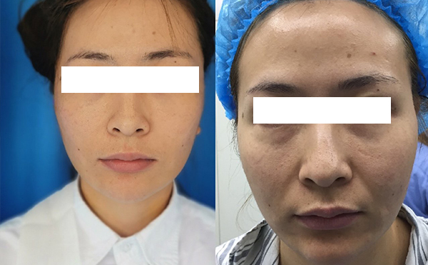 拉皮和線雕哪個(gè)效果好？