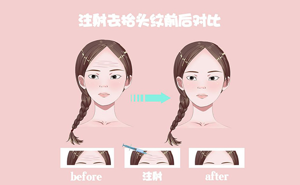 電波拉皮怎么去除抬頭紋？