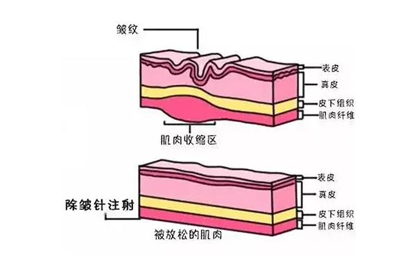 注射除皺是什么原理？