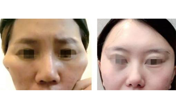 筋膜懸吊除皺有什么副作用？