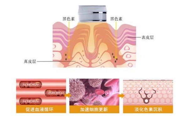 光子嫩膚效果好不好？