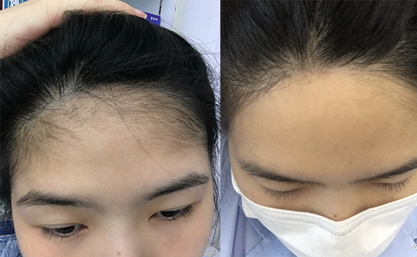 激光脫發(fā)際線的過程是什么？