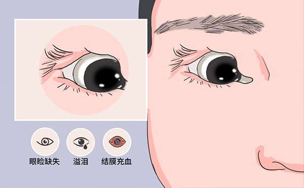 先天性眼瞼缺損會(huì)遺傳嗎?先天性眼瞼缺損怎么辦?