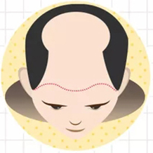 七級脫發(fā)
