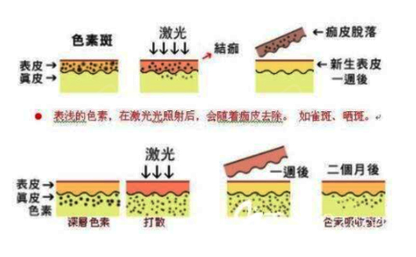 光子嫩膚和皮秒有什么區(qū)別？
