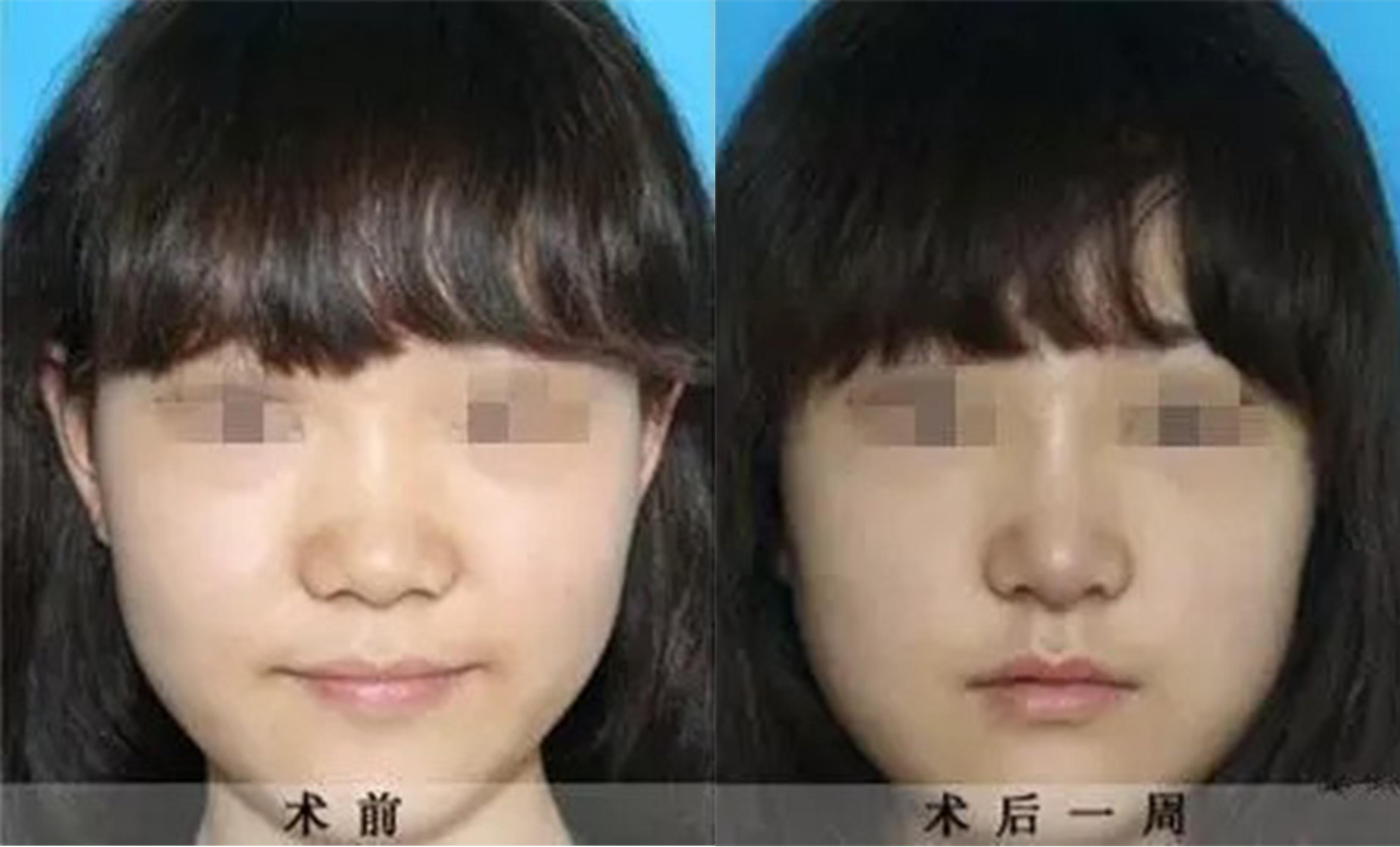 鼻頭、鼻翼縮小