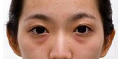 激光去黑眼圈術前