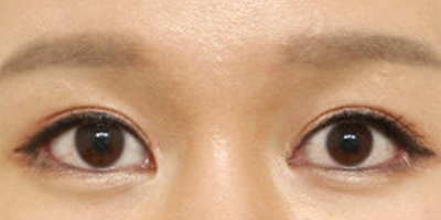 開(kāi)外眼角術(shù)后