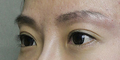 玻尿酸豐眉弓術后