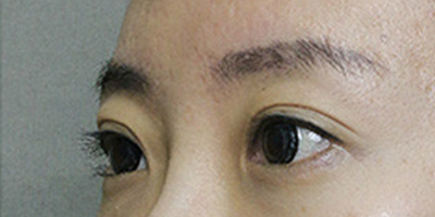 玻尿酸豐眉弓術前