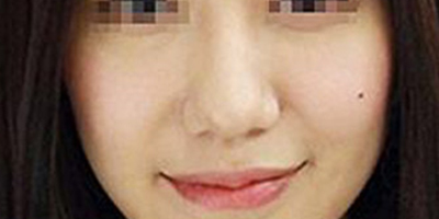 膠原蛋白填充蘋果肌術后