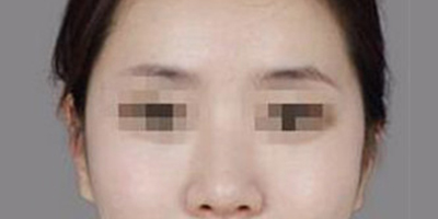 顴骨內推術后