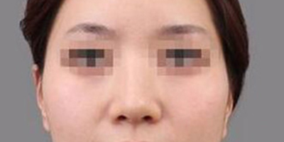 顴骨內推術前