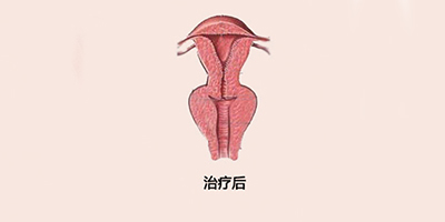 手術(shù)緊縮陰道術(shù)后