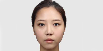 手術縮鼻翼術前